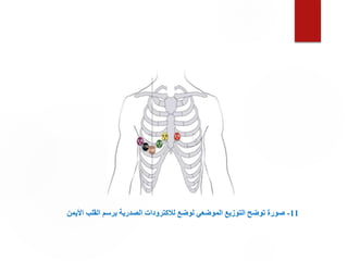 1
1
-
‫األيمن‬ ‫القلب‬ ‫برسم‬ ‫الصدرية‬ ‫لالكترودات‬ ‫لوضع‬ ‫الموضعي‬ ‫التوزيع‬ ‫توضح‬ ‫صورة‬
 