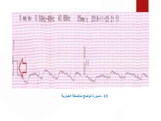 13
-
‫العيارية‬ ‫مناصفة‬ ‫توضح‬ ‫صورة‬
 
