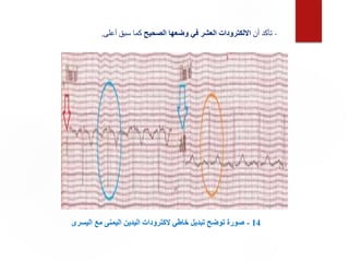 14
-
‫اليس‬ ‫مع‬ ‫اليمنى‬ ‫اليدين‬ ‫الكترودات‬ ‫خاطي‬ ‫تبديل‬ ‫توضح‬ ‫صورة‬
‫رى‬
-
‫أن‬ ‫تأكد‬
‫الصحيح‬ ‫وضعها‬ ‫في‬ ‫العشر‬ ‫االلكترودات‬
‫أع‬ ‫سبق‬ ‫كما‬
‫لى‬
.
 