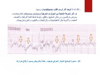 15
-
‫لوجود‬ ‫الحركي‬ ‫المؤثر‬ ‫توضح‬ ‫صورة‬
‫حرارته‬ ‫ارتفاع‬ ‫بسبب‬ ‫بالمريض‬ ‫رعشة‬
-
‫ال‬ ‫أنه‬ ‫تأكد‬
‫القلب‬ ‫لرسم‬ ‫آثار‬ ‫توجد‬
(
Artifacts
)
‫ومنها‬ ،
:
1
-
‫الحركية‬ ‫المؤثرات‬ ‫من‬ ‫الناتجة‬ ‫الحركة‬ ‫آثار‬
(
Motion artifact
:)
،‫كاالرتعاشات‬
‫والتص‬ ،‫الدرقية‬ ‫الغدة‬ ‫نشاط‬ ‫وفرط‬ ،‫والقلق‬ ،‫المخيخ‬ ‫ورعاش‬ ،‫باركنسون‬ ‫ومرض‬
‫لب‬
‫والبنزودياز‬ ،‫والليثيوم‬ ،‫والزانثينات‬ ،‫األمفيتامينات‬ ‫مثل‬ ‫واألدوية‬ ،‫المتعدد‬
‫يبينات‬
.
 
