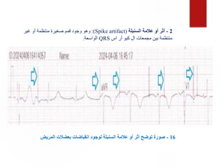 16
-
‫المريض‬ ‫بعضالت‬ ‫انقباضات‬ ‫لوجود‬ ‫السنبلة‬ ‫عالمة‬ ‫أو‬ ‫أثر‬ ‫توضح‬ ‫صورة‬
2
-
‫السنبلة‬ ‫عالمة‬ ‫أو‬ ‫أثر‬
(
Spike artifact
:)
‫غير‬ ‫أو‬ ‫منتظمة‬ ‫صغيرة‬ ‫قمم‬ ‫وجود‬ ‫وهو‬
‫اس‬ ‫أر‬ ‫كيو‬ ‫ال‬ ‫مجمعات‬ ‫بين‬ ‫منتظمة‬
QRS
‫الواسعة‬
.
 