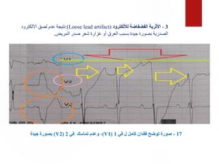17
-
‫في‬ ‫ل‬ ‫كامل‬ ‫فقدان‬ ‫توضح‬ ‫صورة‬
1
(
V1
)
‫في‬ ‫تماسك‬ ‫وعدم‬ ،
2
(
V2
)
‫جيدة‬ ‫بصورة‬
3
-
‫لأللكترود‬ ‫الفضفاضة‬ ‫األثرية‬
(
Loose lead artifact
:)
‫االلكترود‬ ‫لصق‬ ‫عدم‬ ‫نتيجة‬
‫المريض‬ ‫صدر‬ ‫شعر‬ ‫غزارة‬ ‫أو‬ ‫العرق‬ ‫بسبب‬ ‫جيدة‬ ‫بصورة‬ ‫الصدرية‬
.
 