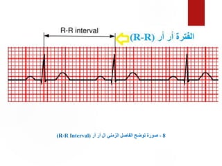 8
-
‫أر‬ ‫أر‬ ‫ال‬ ‫الزمني‬ ‫الفاصل‬ ‫توضح‬ ‫صورة‬
(
R-R Interval
)
 