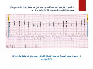 19
-
‫الرفر‬ ‫مثل‬ ‫منتظم‬ ‫غير‬ ‫إيقاع‬ ‫وجود‬ ‫في‬ ‫القلب‬ ‫ضربات‬ ‫معدل‬ ‫على‬ ‫الحصول‬ ‫توضح‬ ‫صورة‬
‫فة‬
‫األذينية‬
(
AF
)
-
‫منتظم‬ ‫غير‬ ‫إيقاع‬ ‫وجود‬ ‫في‬ ‫القلب‬ ‫ضربات‬ ‫معدل‬ ‫على‬ ‫للحصول‬
(
irregular rhythm
)
،
‫مدته‬ ‫شريط‬ ‫في‬ ‫الدقات‬ ‫عدد‬ ‫احسب‬
10
‫في‬ ‫واضربه‬ ٍ‫ثوان‬
6
.
 