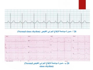 20
‫أ‬
-
‫الطبيعي‬ ‫الجرابي‬ ‫لإليقاع‬ ‫موضحة‬ ‫صورة‬
(Normal sinus rhythm)
20
‫ب‬
-
‫الطبيعي‬ ‫الجرابي‬ ‫لإليقاع‬ ‫موضحة‬ ‫صورة‬
(Normal
sinus rhythm)
 