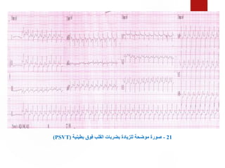 21
-
‫بطينية‬ ‫فوق‬ ‫القلب‬ ‫بضربات‬ ‫للزيادة‬ ‫موضحة‬ ‫صورة‬
(
PSVT
)
 