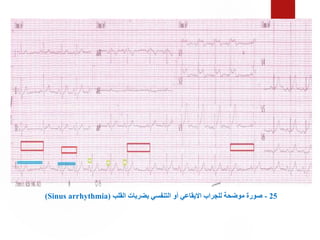 25
-
‫القلب‬ ‫بضربات‬ ‫التنفسي‬ ‫أو‬ ‫االيقاعي‬ ‫للجراب‬ ‫موضحة‬ ‫صورة‬
(Sinus arrhythmia)
 