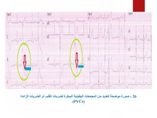 26
-
‫الزا‬ ‫الضربات‬ ‫أو‬ ‫القلب‬ ‫لضربات‬ ‫المبكرة‬ ‫البطينية‬ ‫المجمعات‬ ‫من‬ ‫للعديد‬ ‫موضحة‬ ‫صورة‬
‫ئدة‬
(PVCs)
 
