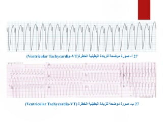 27
‫أ‬
-
‫الخطرة‬ ‫البطينية‬ ‫للزيادة‬ ‫موضحة‬ ‫صورة‬
(Ventricular Tachycardia-VT)
27
‫ب‬
-
‫الخطرة‬ ‫البطينية‬ ‫للزيادة‬ ‫موضحة‬ ‫صورة‬
(Ventricular Tachycardia-VT)
 