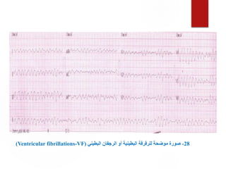 28
-
‫البطيني‬ ‫الرجفان‬ ‫أو‬ ‫البطينية‬ ‫للرفرفة‬ ‫موضحة‬ ‫صورة‬
(
Ventricular fibrillations-VF
)
 