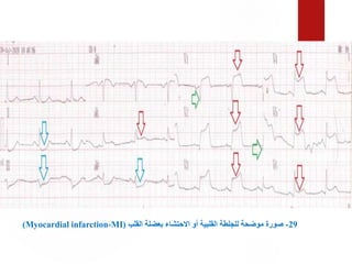 29
-
‫القلب‬ ‫بعضلة‬ ‫االحتشاء‬ ‫أو‬ ‫القلبية‬ ‫للجلطة‬ ‫موضحة‬ ‫صورة‬
(
Myocardial infarction-MI
)
 