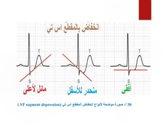 30
‫أ‬
-
‫تي‬ ‫اس‬ ‫المقطع‬ ‫انخفاض‬ ‫ألنواع‬ ‫موضحة‬ ‫صورة‬
(
ST segment depression
)
 