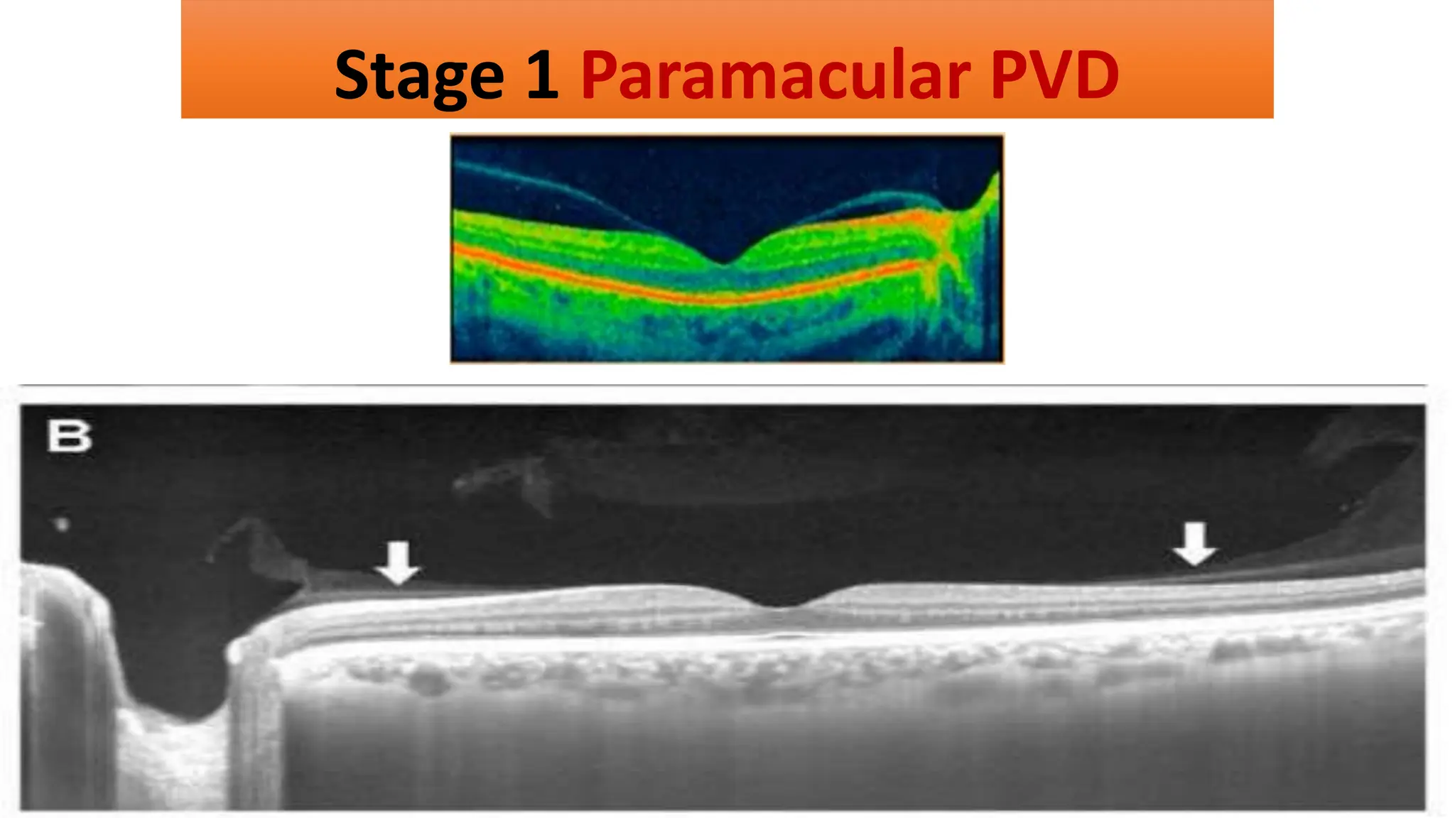 Stage 1 Paramacular PVD