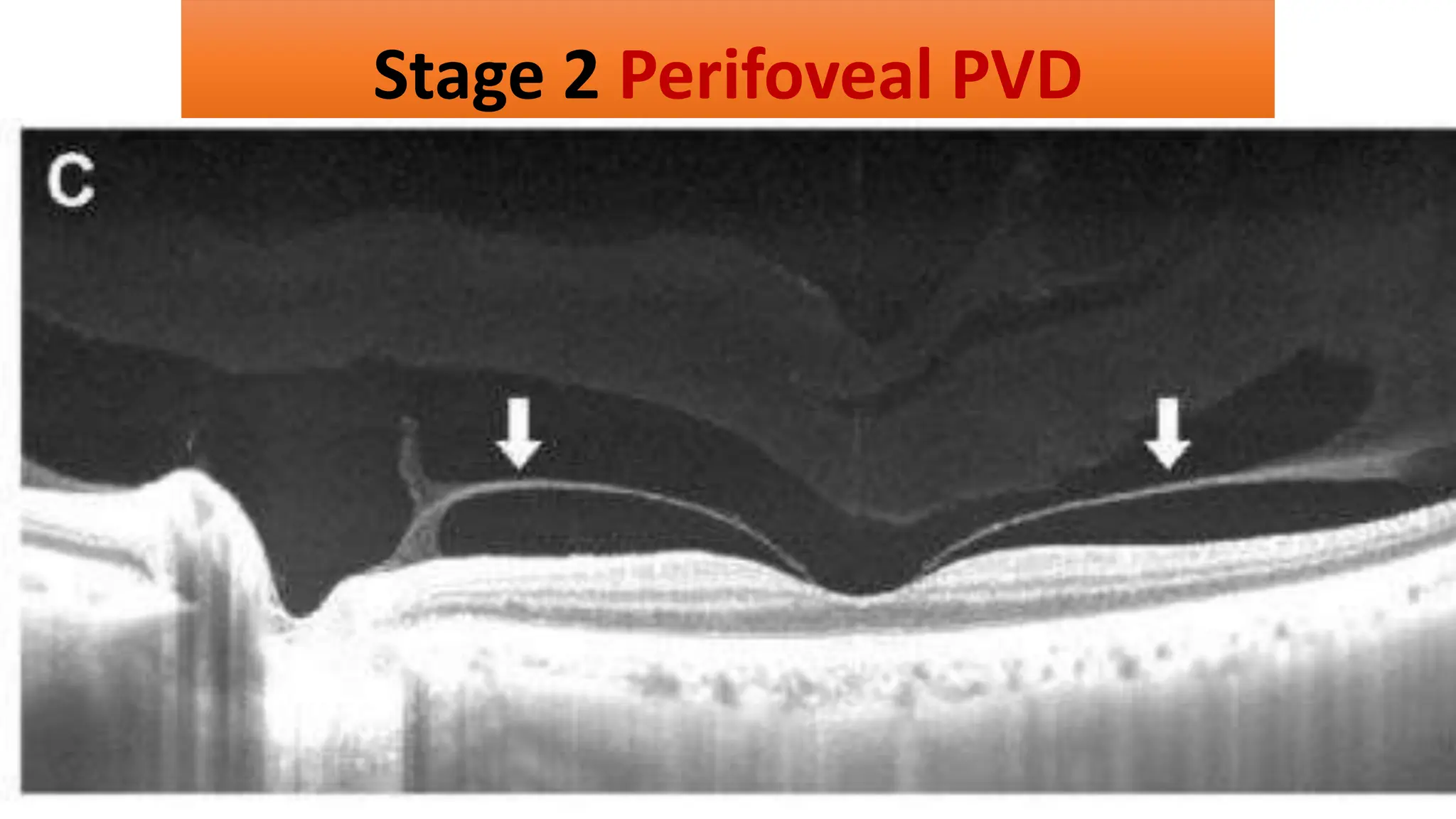 Stage 2 Perifoveal PVD