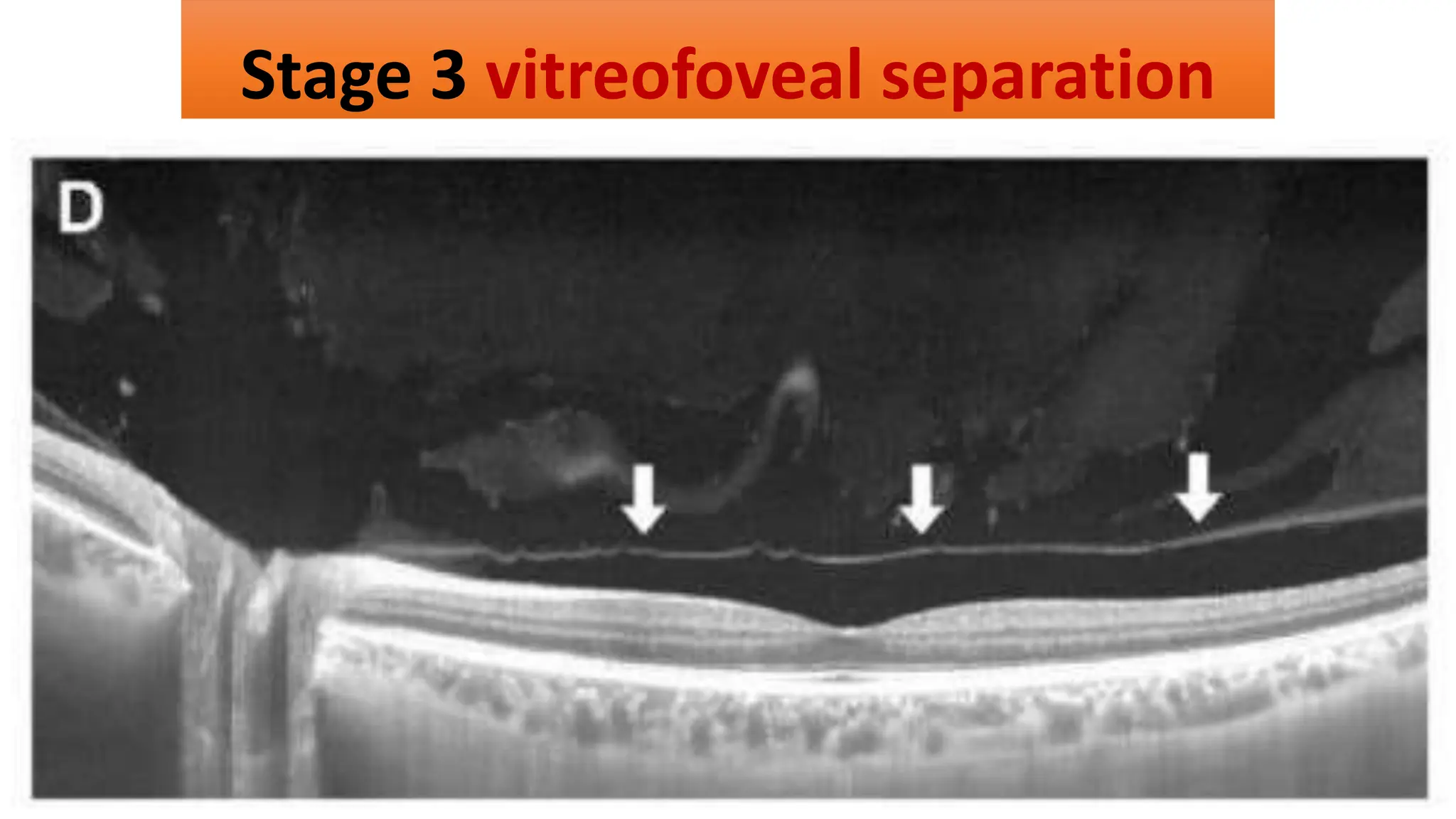 Stage 3 vitreofoveal separation