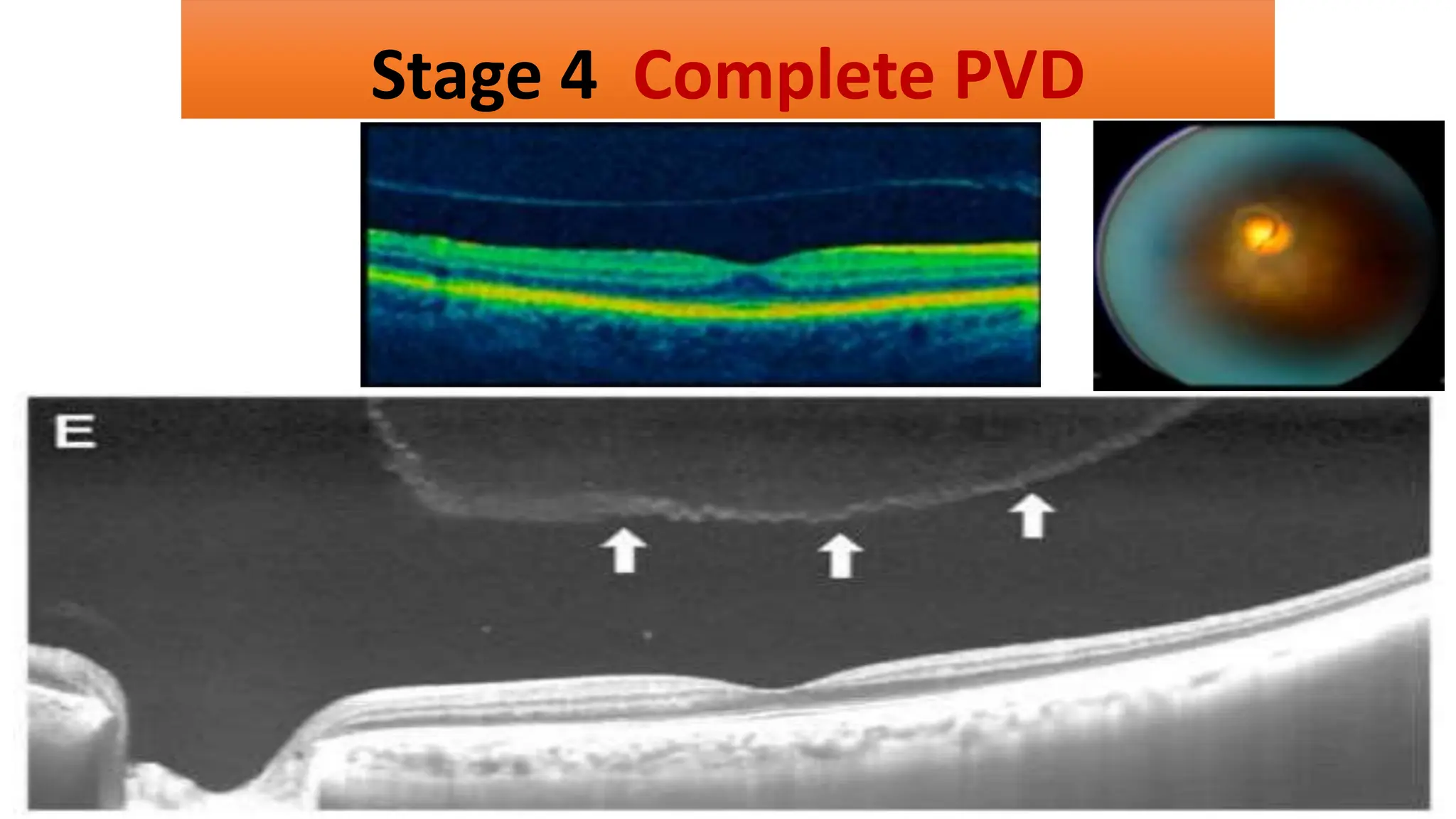 Stage 4 Complete PVD