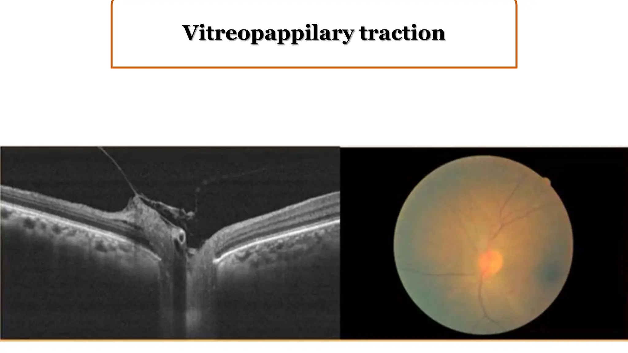 Vitreopappilary traction