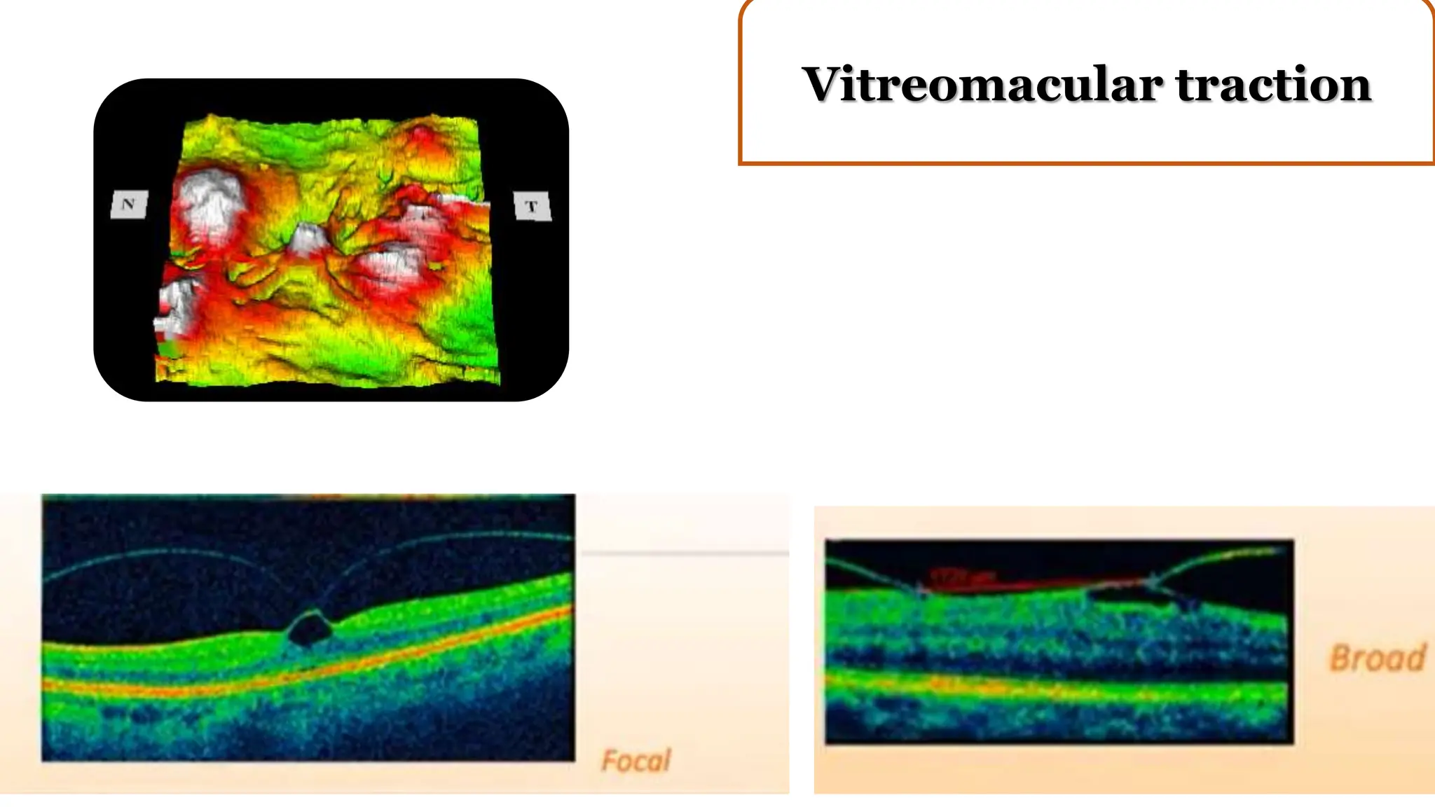 Vitreomacular traction