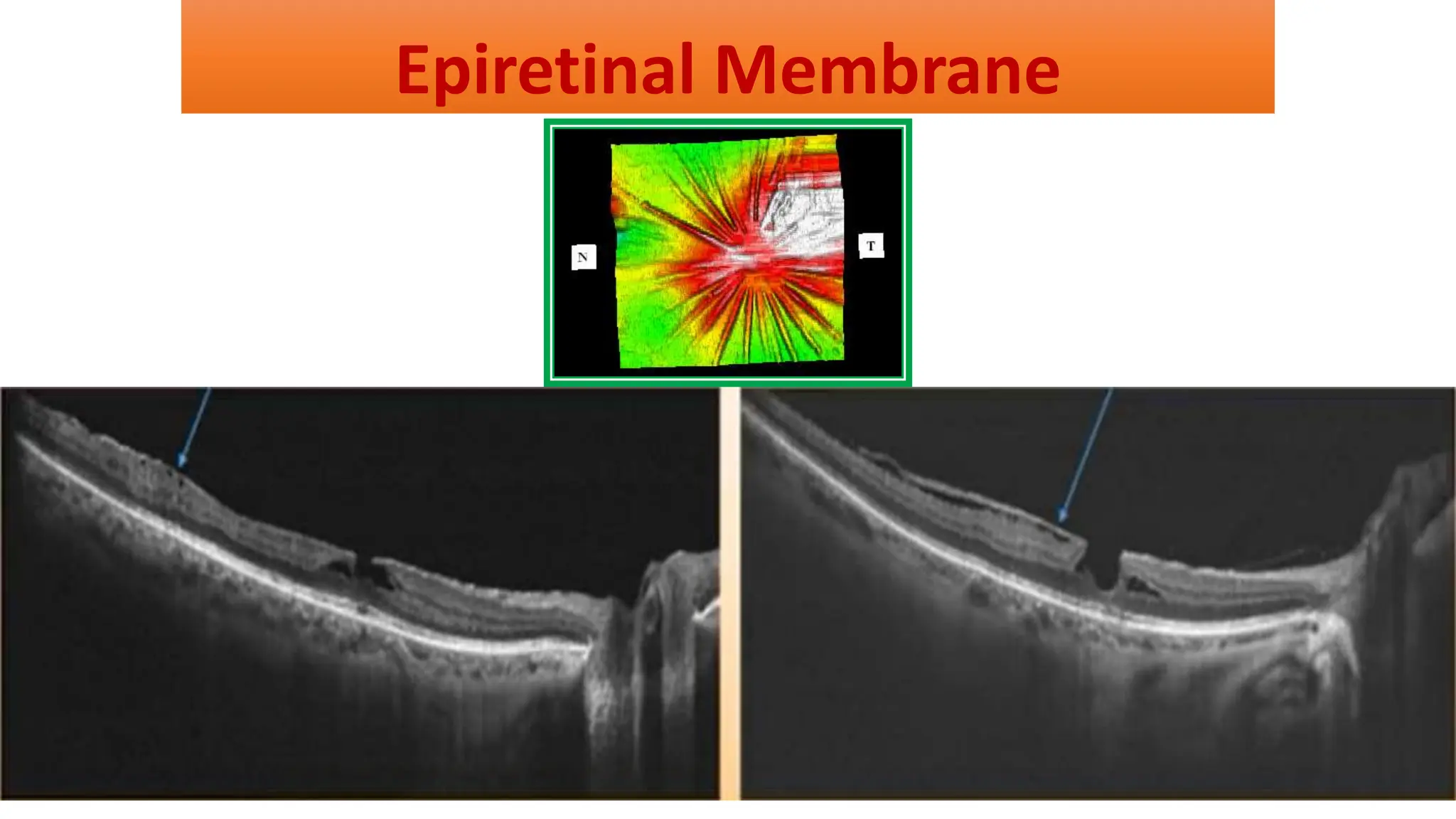 Epiretinal Membrane