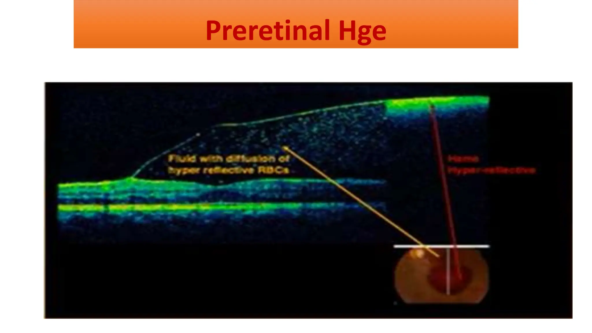 Preretinal Hge