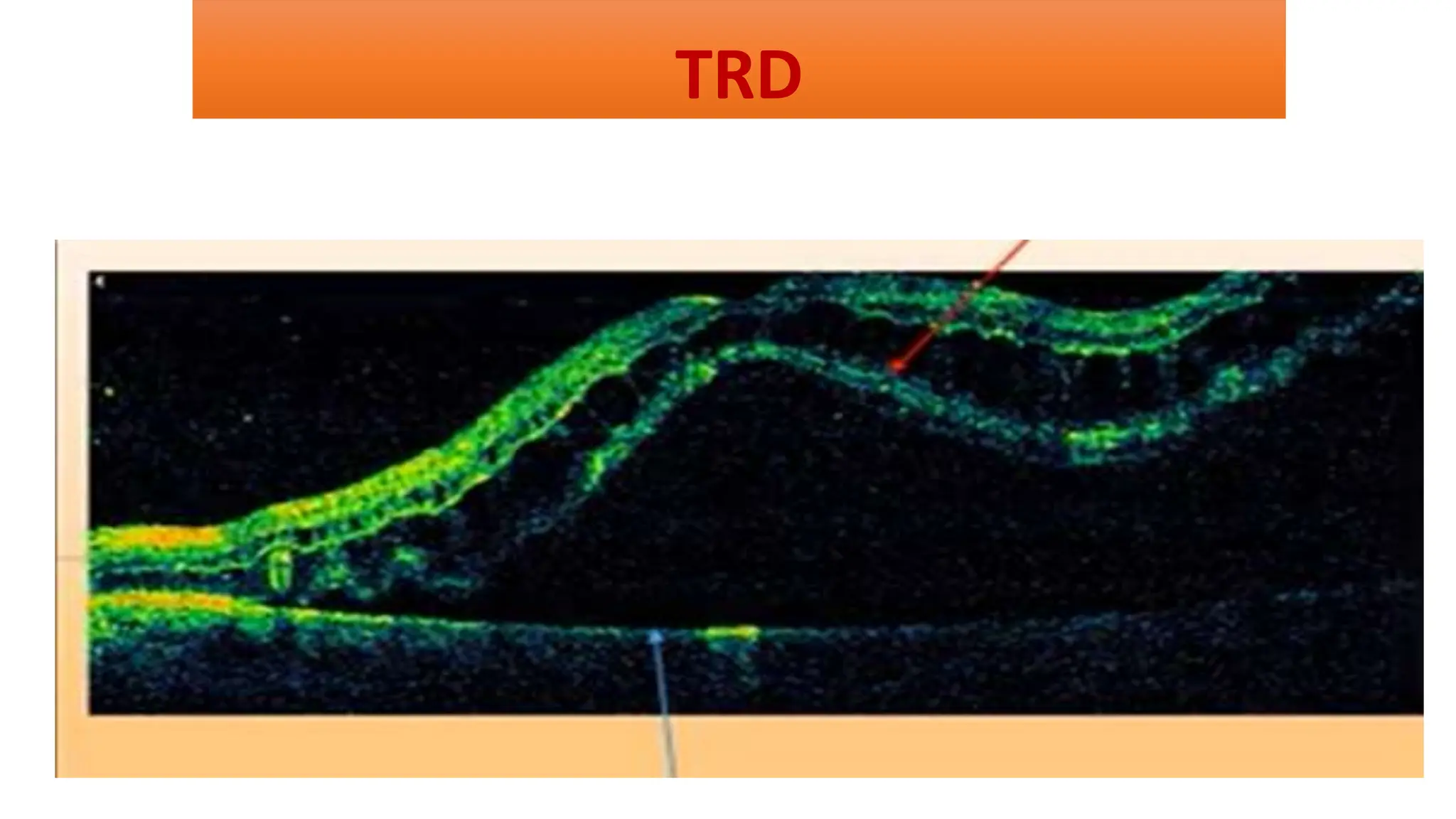TRD