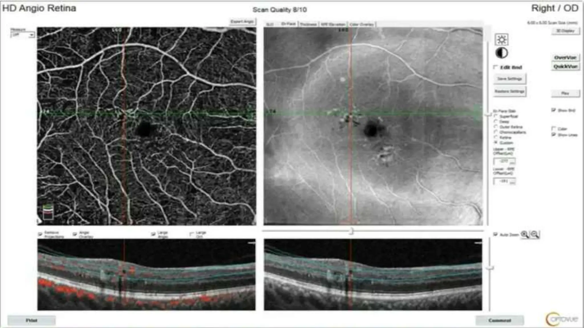 OCT and OCTA in DR practical discussions