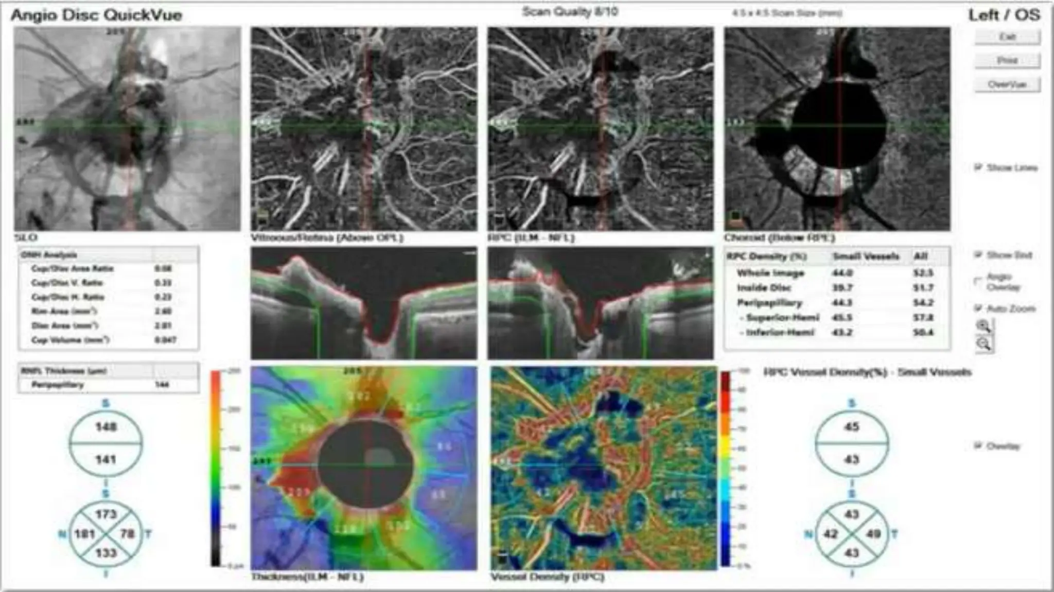 OCT and OCTA in DR practical discussions