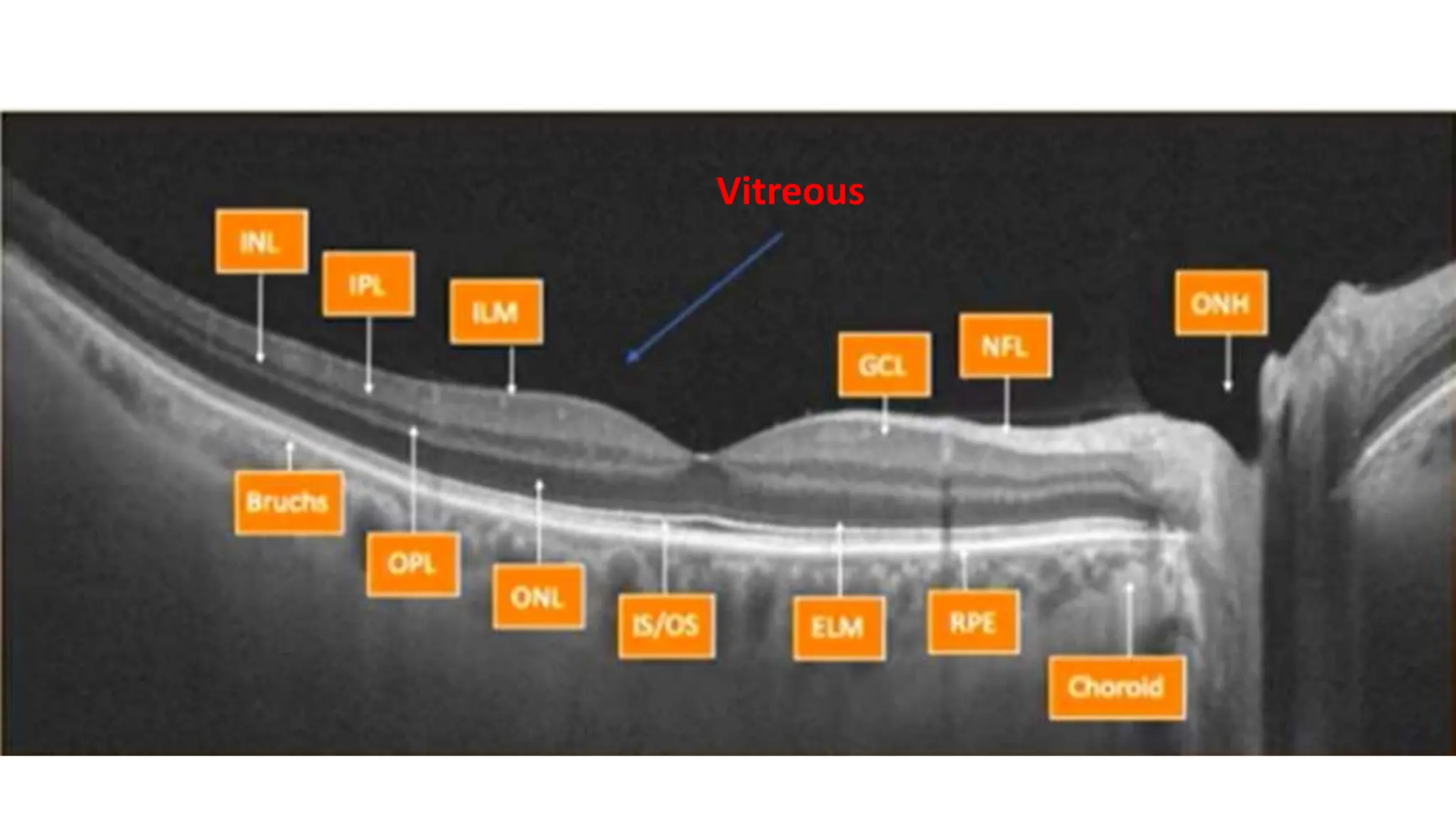 Vitreous