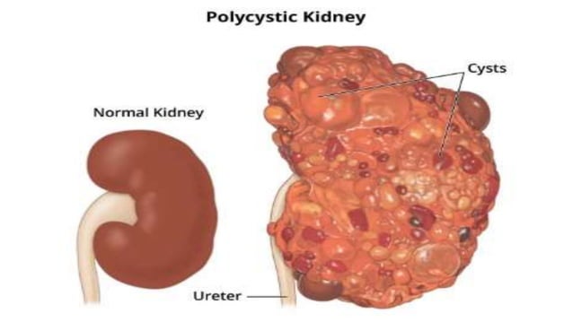 Polycystic kidney disease PowerPoint.pptx