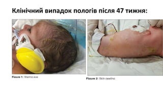 Клінічний випадок пологів після 47 тижня:
 