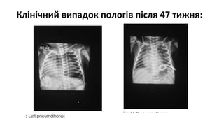 Клінічний випадок пологів після 47 тижня:
 