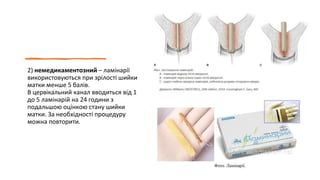 2) немедикаментозний – ламінарії
використовуються при зрілості шийки
матки менше 5 балів.
В цервікальний канал вводиться від 1
до 5 ламінарій на 24 години з
подальшою оцінкою стану шийки
матки. За необхідності процедуру
можна повторити.
 