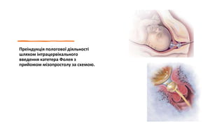 Преіндукція пологової діяльності
шляхом інтрацервікального
введення катетера Фолея з
прийомом мізопростолу за схемою.
 