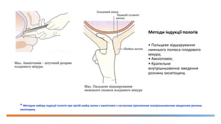 Методи індукції пологів
• Пальцеве відшарування
нижнього полюса плодового
міхура;
• Амніотомія;
• Крапельне
внутрішньовенне введення
розчину окситоцину.
* Методом вибору індукції пологів при зрілій шийці матки є амніотомія з наступним краплинним внутрішньовенним введенням розчину
окситоцину.
 