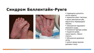Синдром Беллентайн-Рунге
• підвищена щільність
кісток черепа;
• звуження швів і тім'ячок;
• різке зменшення або
відсутність первородної
змазки;
• зменшення підшкірно-
жирового шару;
• зниження тургору шкіри;
• лущення шкіри,
«руки пралі», «банні
ступні»;
• збільшення довжини
нігтів;
• щільні хрящі вушних
раковин і носа.
 
