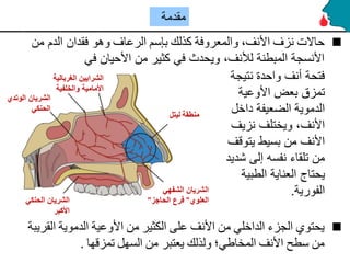 الإسعافات الأولية في حالة نزيف الأنف (الرعاف).ppt