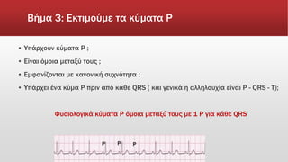 Βήμα 3: Εκτιμούμε τα κύματα P
▪ Υπάρχουν κύματα Ρ ;
▪ Είναι όμοια μεταξύ τους ;
▪ Εμφανίζονται με κανονική συχνότητα ;
▪ Υπάρχει ένα κύμα P πριν από κάθε QRS ( και γενικά η αλληλουχία είναι P - QRS - T);
Φυσιολογικά κύματα P όμοια μεταξύ τους με 1 P για κάθε QRS
P P P
 