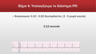 Βήμα 4: Υπολογίζουμε το διάστημα PR:
▪ Φυσιολογικό: 0.12 - 0.20 δευτερόλεπτα. (3 - 5 μικρά κουτιά)
0.12 seconds
→
 