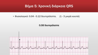 Βήμα 5: Χρονική διάρκεια QRS
▪ Φυσιολογικό: 0.04 - 0.12 δευτερόλεπτα. (1 - 3 μικρά κουτιά)
0.08 δευτερόλεπτα
►
 