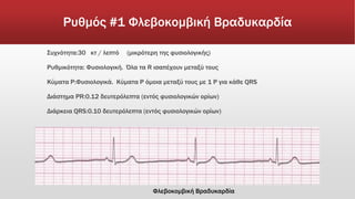 Ρυθμός #1 Φλεβοκομβική Βραδυκαρδία
Συχνότητα:30 κτ / λεπτό (μικρότερη της φυσιολογικής)
Ρυθμικότητα: Φυσιολογική. Όλα τα R ισαπέχουν μεταξύ τους
Κύματα Ρ:Φυσιολογικά. Κύματα P όμοια μεταξύ τους με 1 P για κάθε QRS
Διάστημα PR:0.12 δευτερόλεπτα (εντός φυσιολογικών ορίων)
Διάρκεια QRS:0.10 δευτερόλεπτα (εντός φυσιολογικών ορίων)
Φλεβοκομβική Βραδυκαρδία
 