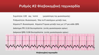 Ρυθμός #2 Φλεβοκομβική ταχυκαρδία
Συχνότητα: 130 σφ / λεπτό (μεγαλύτερη της φυσιολογικής)
Ρυθμικότητα: Φυσιολογική. Όλα τα R ισαπέχουν μεταξύ τους
Κύματα Ρ: Φυσιολογικά. Κύματα P όμοια μεταξύ τους με 1 P για κάθε QRS
Διάστημα PR: 0.16 δευτερόλεπτα (εντός φυσιολογικών ορίων)
Διάρκεια QRS: 0,08 δευτερόλεπτα (εντός φυσιολογικών ορίων)
Φλεβοκομβική ταχυκαρδία
 