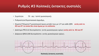 Ρυθμός #3 Κολπικές έκτακτες συστολές
▪ Συχνότητα: 70 σφ / λεπτό (φυσιολογική).
▪ Ρυθμικότητα:Περιστασιακά άρρυθμη.
▪ Κύματα Ρ:Κύματα P φυσιολογικά όμοια μεταξύ τους με 1 P για κάθε QRS εκτός από τα
#2 και #7 τα οποία δεν είναι όμοια με τα υπόλοιπα.
▪ Διάστημα PR:0.14 δευτερόλεπτα (εντός φυσιολογικών ορίων) εκτός από τα #2 και #7
▪ Διάρκεια QRS:0,08 δευτερόλεπτα (εντός φυσιολογικών ορίων).
Κολπικές έκτακτες συστολές
 