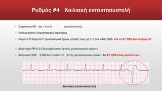 Ρυθμός #4 Κοιλιακή εκτακτοσυστολή
▪ Συχνότητα:60 σφ / λεπτό (φυσιολογική).
▪ Ρυθμικότητα: Περιστασιακά άρρυθμη.
▪ Κύματα Ρ:Κύματα P φυσιολογικά όμοια μεταξύ τους με 1 P για κάθε QRS. Για το #7 QRS δεν υπάρχει P.
▪ Διάστημα PR:0.14 δευτερόλεπτα (εντός φυσιολογικών ορίων)
▪ Διάρκεια QRS: 0,08 δευτερόλεπτα (εντός φυσιολογικών ορίων). To #7 QRS είναι μεγαλύτερο.
Κοιλιακή εκτακτοσυστολή
 