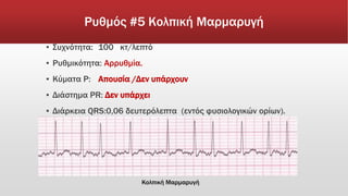 Ρυθμός #5 Κολπική Μαρμαρυγή
▪ Συχνότητα: 100 κτ/λεπτό
▪ Ρυθμικότητα: Αρρυθμία.
▪ Κύματα Ρ: Απουσία /Δεν υπάρχουν
▪ Διάστημα PR: Δεν υπάρχει
▪ Διάρκεια QRS:0,06 δευτερόλεπτα (εντός φυσιολογικών ορίων).
Κολπική Μαρμαρυγή
 