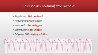 Ρυθμός #6 Κοιλιακή ταχυκαρδία
▪ Συχνότητα: 160 κτ/λεπτό
▪ Ρυθμικότητα: Φυσιολογική
▪ Κύματα Ρ: Δεν υπάρχουν
▪ Διάστημα PR: Δεν υπάρχει
▪ Διάρκεια QRS: μεγάλη > 0,12s
 