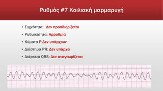 Ρυθμός #7 Κοιλιακή μαρμαρυγή
▪ Συχνότητα: Δεν προσδιορίζεται
▪ Ρυθμικότητα: Αρρυθμία
▪ Κύματα Ρ:Δεν υπάρχουν
▪ Διάστημα PR: Δεν υπάρχει
▪ Διάρκεια QRS: Δεν αναγνωρίζεται
 