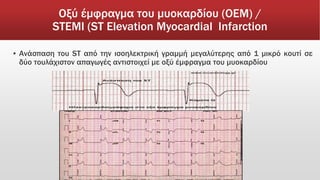 Οξύ έμφραγμα του μυοκαρδίου (ΟΕΜ) /
STEMI (ST Elevation Myocardial Infarction
▪ Ανάσπαση του ST από την ισοηλεκτρική γραμμή μεγαλύτερης από 1 μικρό κουτί σε
δύο τουλάχιστον απαγωγές αντιστοιχεί με οξύ έμφραγμα του μυοκαρδίου
 