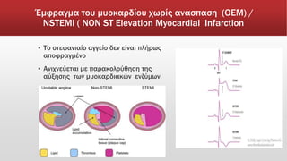 Έμφραγμα του μυοκαρδίου χωρίς ανασπαση (ΟΕΜ) /
ΝSTEMI ( ΝΟΝ ST Elevation Myocardial Infarction
▪ Το στεφανιαίο αγγείο δεν είναι πλήρως
αποφραγμένο
▪ Ανιχνεύεται με παρακολούθηση της
αύξησης των μυοκαρδιακών ενζύμων
 