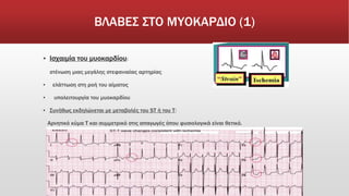 ΒΛΑΒΕΣ ΣΤΟ ΜΥΟΚΑΡΔΙΟ (1)
▪ Ισχαιμία του μυοκαρδίου:
στένωση μιας μεγάλης στεφανιαίας αρτηρίας
▪ ελάττωση στη ροή του αίματος
▪ υπολειτουργία του μυοκαρδίου
▪ Συνήθως εκδηλώνεται με μεταβολές του ST ή του Τ:
Αρνητικό κύμα Τ και συμμετρικό στις απαγωγές όπου φυσιολογικά είναι θετικό.
 