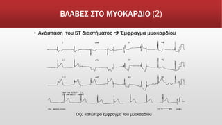 ΒΛΑΒΕΣ ΣΤΟ ΜΥΟΚΑΡΔΙΟ (2)
▪ Ανάσπαση του ST διαστήματος  Έμφραγμα μυοκαρδίου
Οξύ κατώτερο έμφραγμα του μυοκαρδίου
 